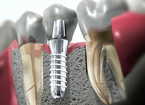Имплантация зубов в Раменском