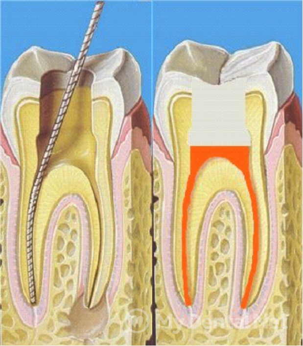Временное пломбирование каналов зуба. Пульпа пульпит периодонтит. 4 Канальный пульпит зуба. Пульпит 2 канального зуба.
